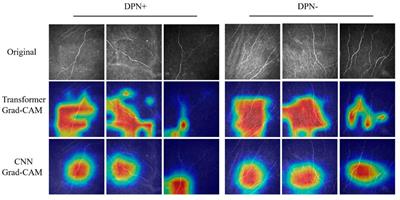 Development of a transformer-based deep learning algorithm for diabetic peripheral neuropathy classification using corneal confocal microscopy images